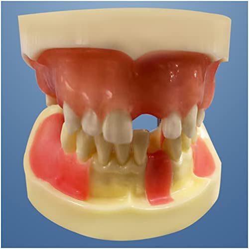 מודל השתלת שיניים של KH66Zky, מודל לימוד שיניים, מודל הוראת שיניים נשלף בפה נשלף